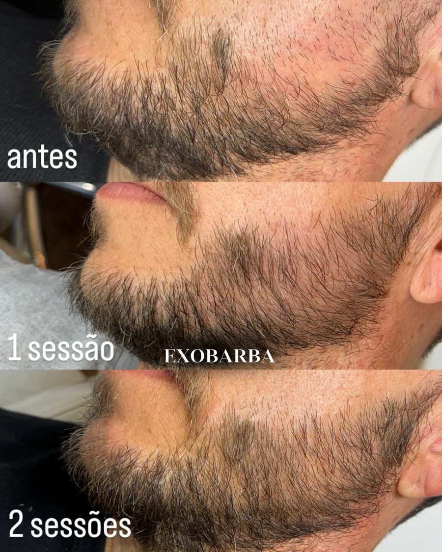 Barba com falhas na bochecha antes, após uma sessão e após duas sessões de regeneração com exossomos