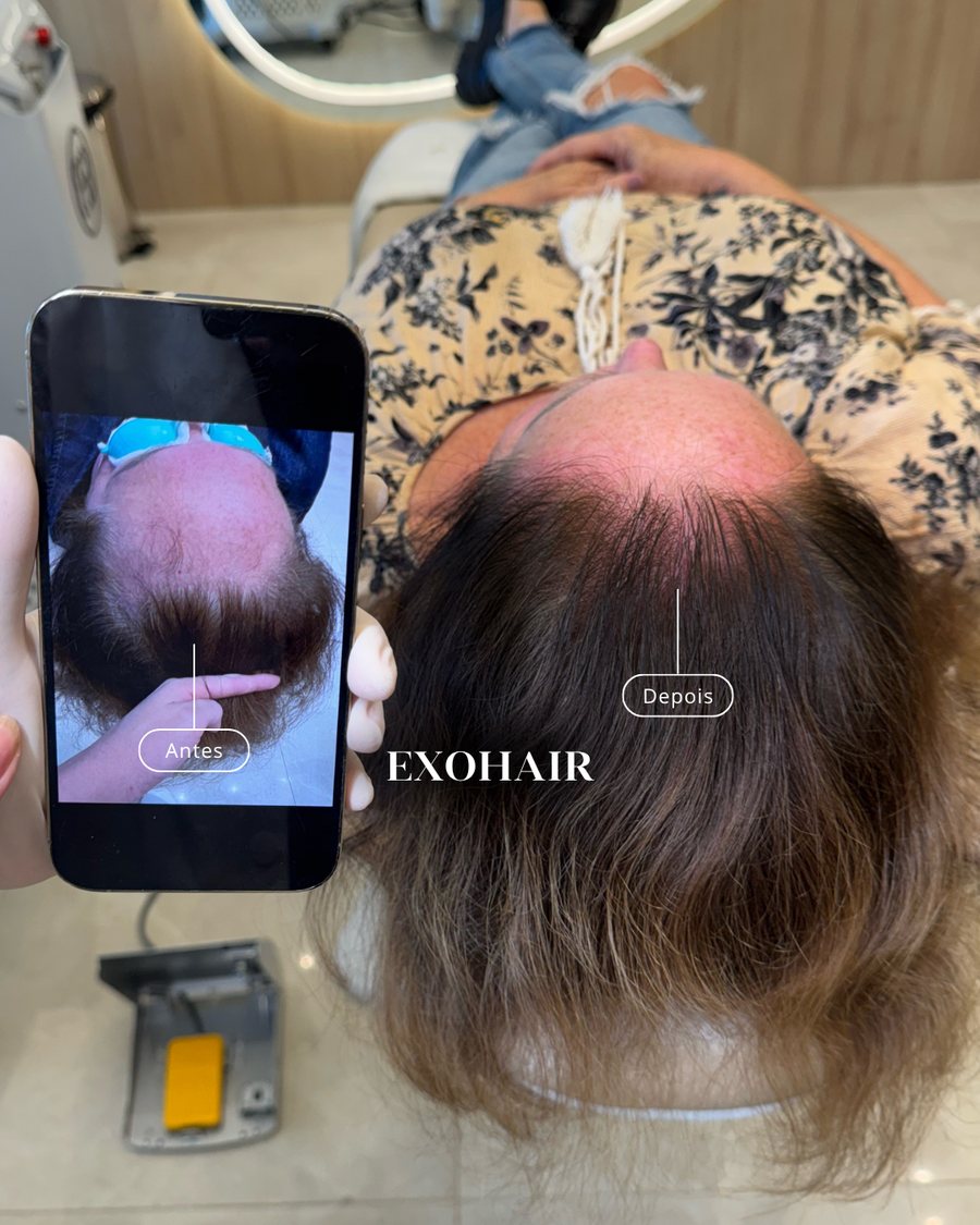 Comparação da coroa: foto anterior no celular ao lado do resultado atual da regeneração capilar