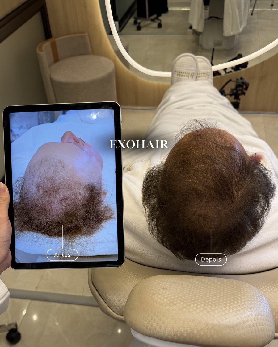 Comparação da coroa: foto anterior no tablet ao lado do resultado atual da regeneração capilar