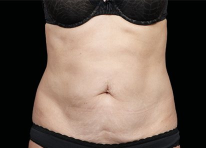 Abdômen antes do EMSCULPT NEO