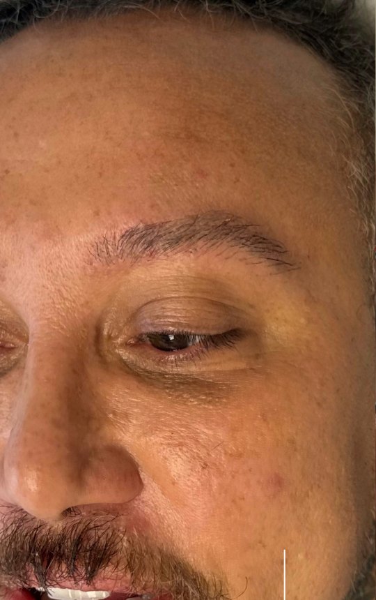 Rosto masculino com manchas antes do protocolo