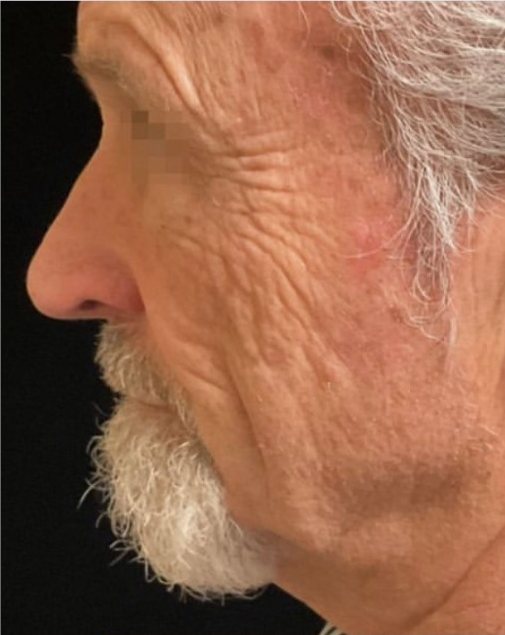 Perfil masculino com papada e flacidez antes do XERF