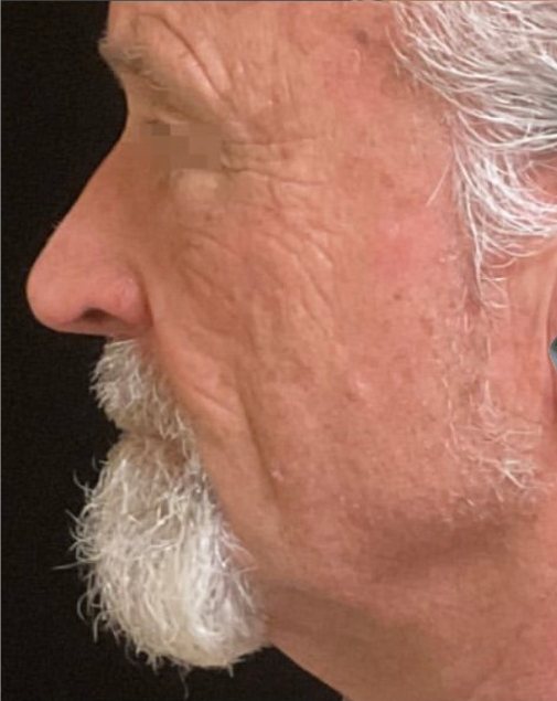 Perfil masculino com contorno mais firme depois do XERF na BTZ Med