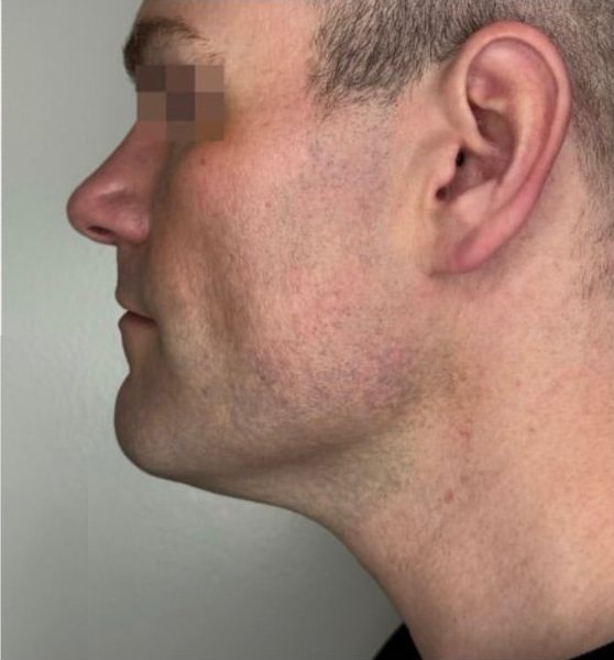 Perfil masculino com mandíbula definida depois do XERF