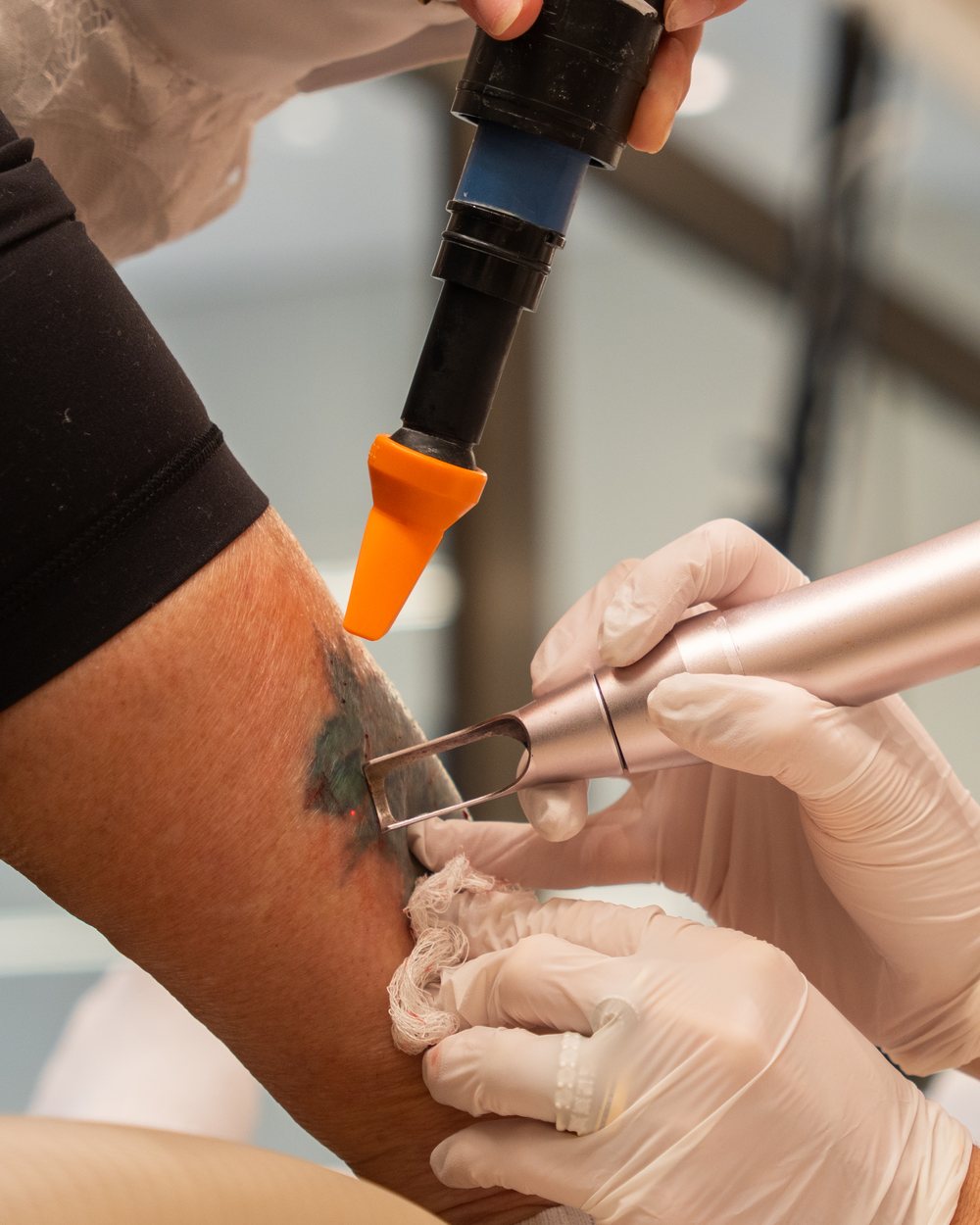 Sessão de remoção de tatuagem a laser no antebraço na BTZ Med, Novo Hamburgo, com resfriamento da pele
