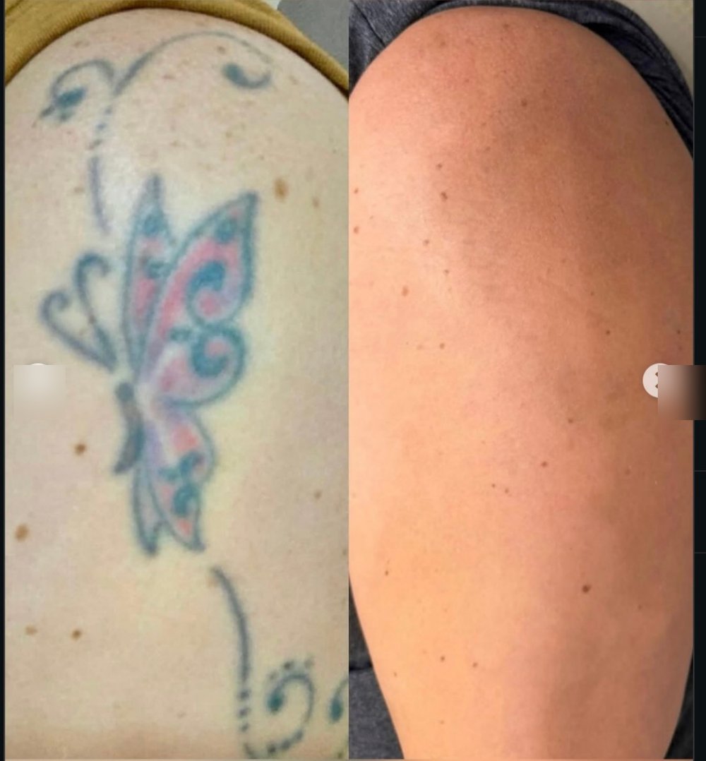 Remoção de tatuagem colorida no ombro: antes e depois