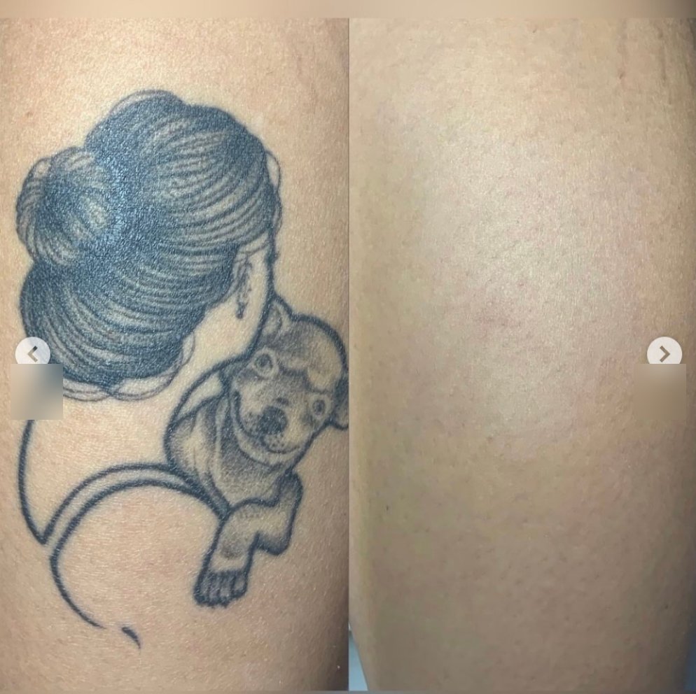 Remoção de tatuagem a laser na perna: antes e depois