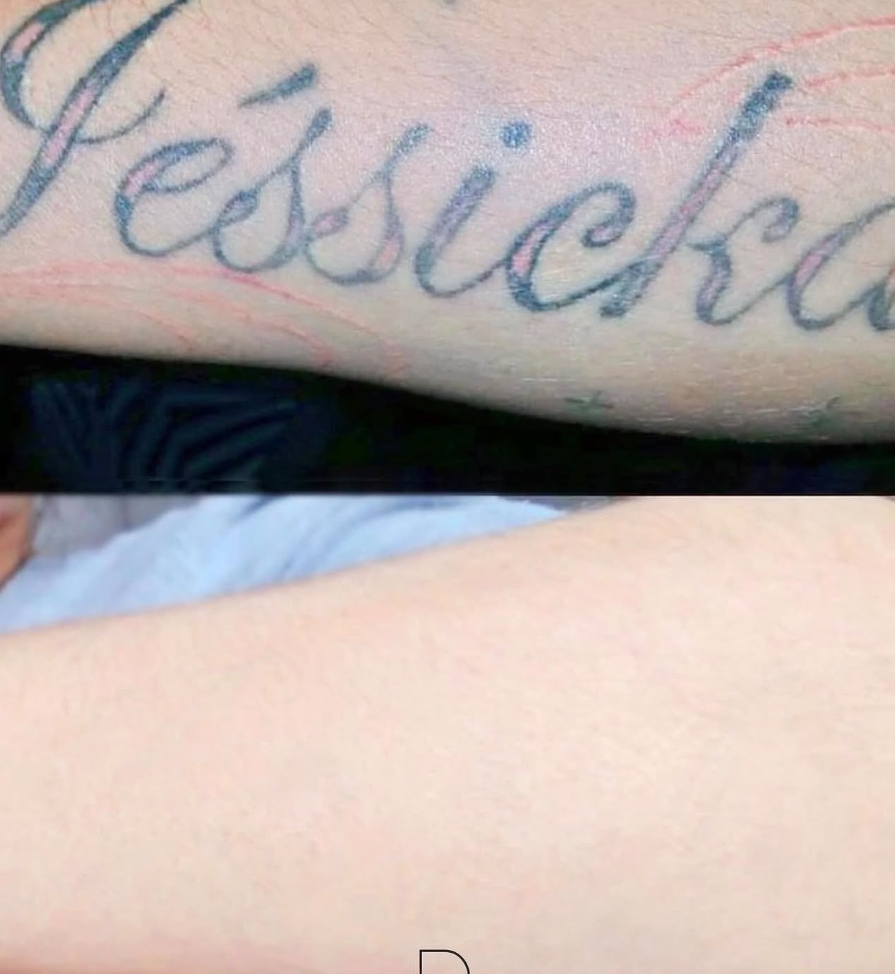 Remoção de tatuagem de nome no antebraço: antes e depois