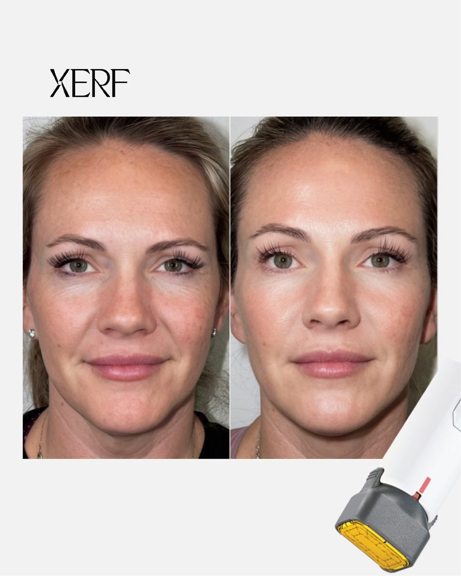 Antes e depois do XERF na BTZ Med, Novo Hamburgo: Rosto