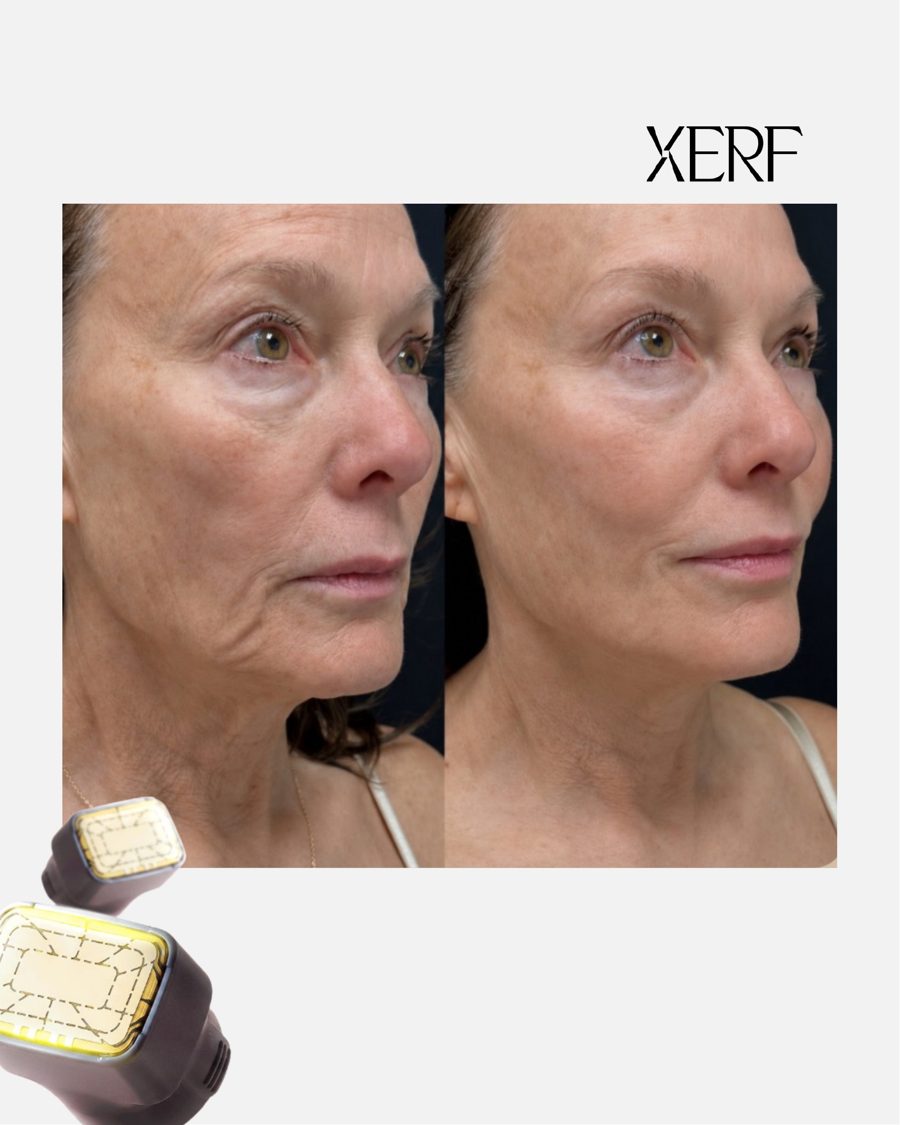 Antes e depois do XERF na BTZ Med, Novo Hamburgo: Rosto