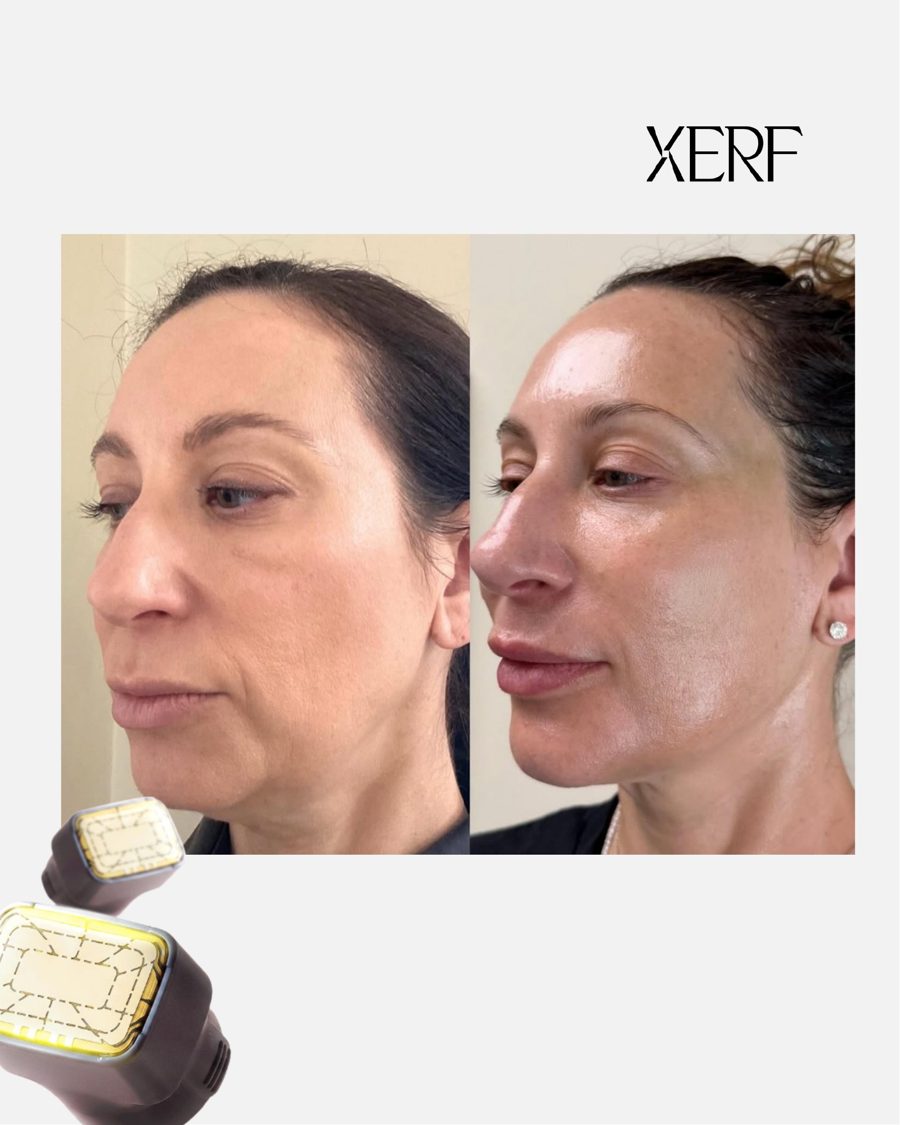 Antes e depois do XERF na BTZ Med, Novo Hamburgo: Linha da mandíbula
