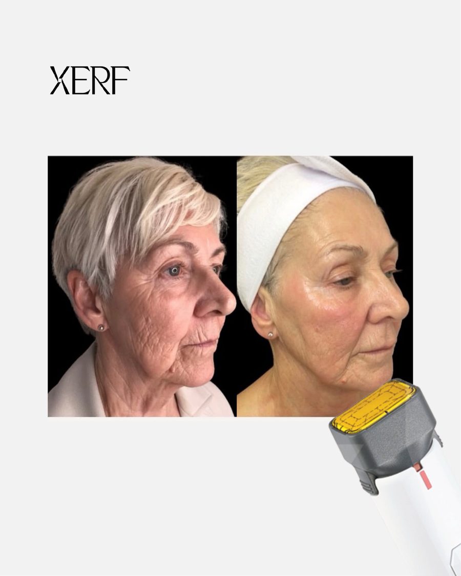 Antes e depois do XERF na BTZ Med, Novo Hamburgo: Rosto