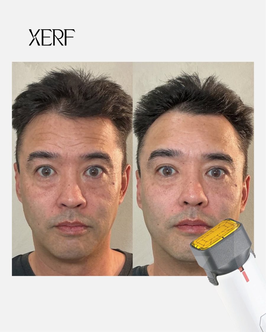Antes e depois do XERF na BTZ Med, Novo Hamburgo: Rosto