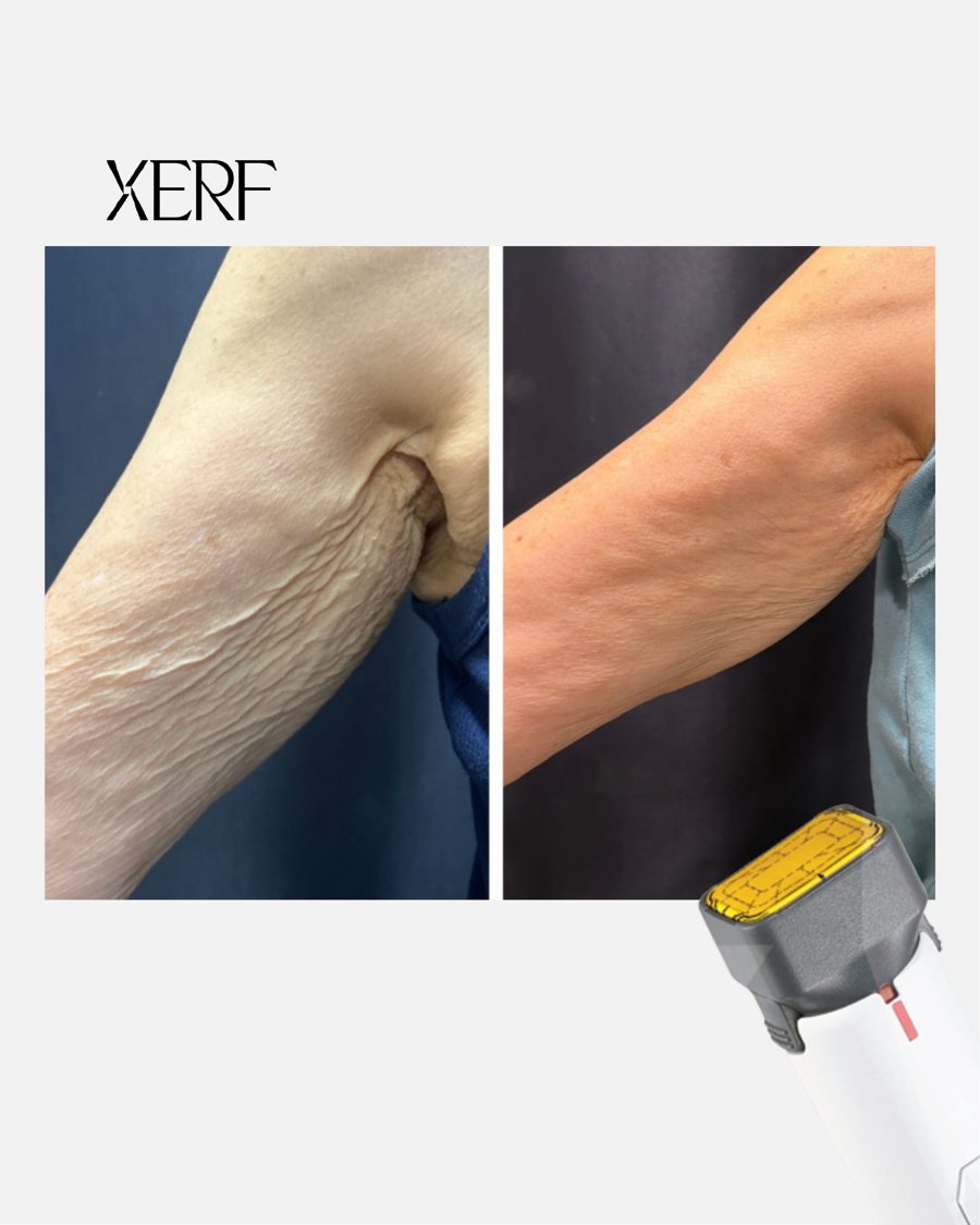 Antes e depois do XERF na BTZ Med, Novo Hamburgo: Braços