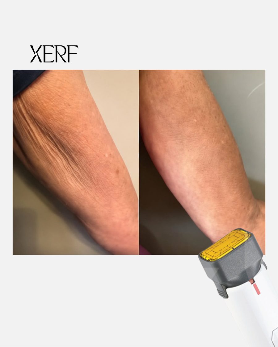 Antes e depois do XERF na BTZ Med, Novo Hamburgo: Braços
