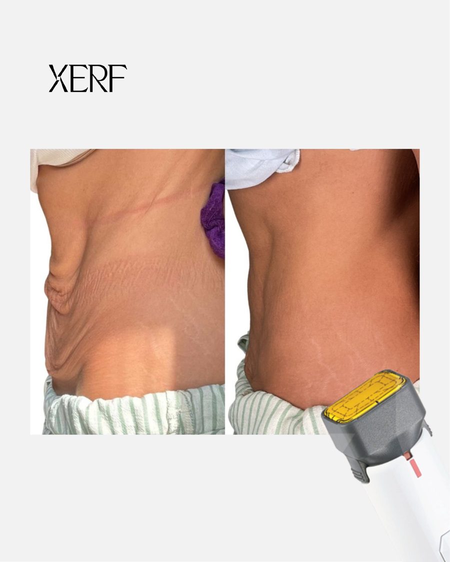 Antes e depois do XERF na BTZ Med, Novo Hamburgo: Abdômen