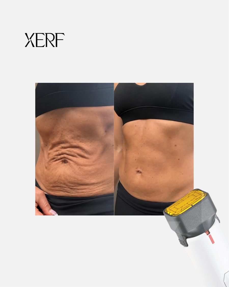 Antes e depois do XERF na BTZ Med, Novo Hamburgo: Abdômen