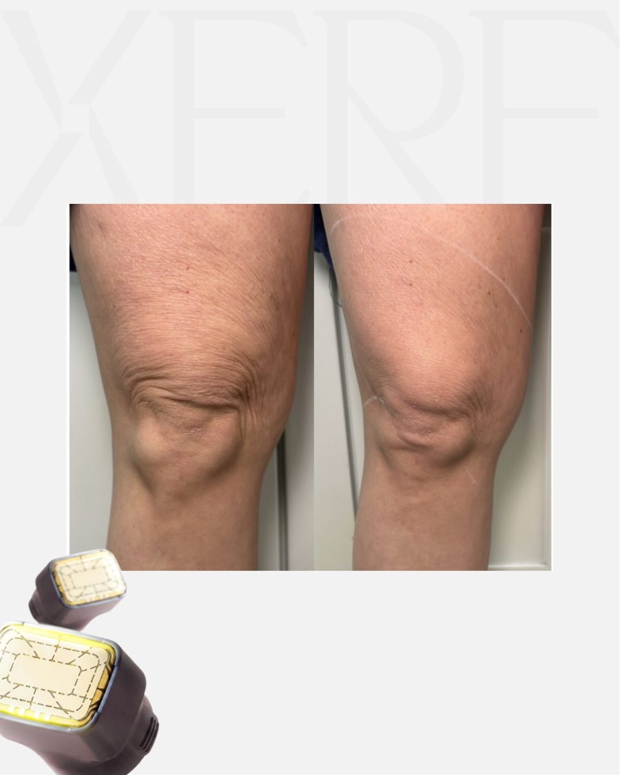 Antes e depois do XERF na BTZ Med, Novo Hamburgo: Joelhos